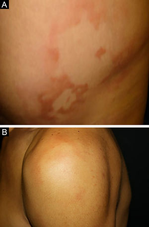 (A), Borderline Leprosy. Well-demarcated erythematous-edematous plaques and papules. (B), Borderline-lepromatous leprosy. Erythematous plaque with a well-defined hypochromic center, and ill-defined outer edges.