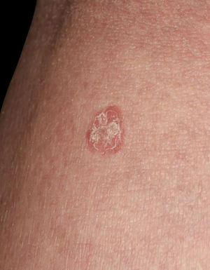 Close-up view showed well-circumscribed, slightly elevated reddish macule with scales.