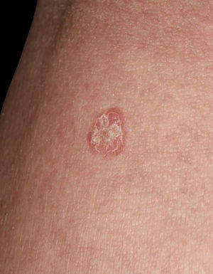 Close-up view showed well-circumscribed, slightly elevated reddish macule with scales.