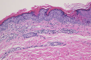 Histological examination showed dyskeratotic cells in the thinned epidermis with cornoid lamella, and absence of granular cell layer. Superﬁcial perivascular lymphocytic inﬁltrate in the dermis was also observed (Hematoxylin & eosin, ×200).