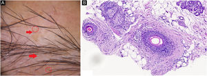 (A), Vellus hairs (red arrow), yellow dots (red circle). (B), Lymphocytic infiltrate with peribulbar fibrosis (Hematoxylin & eosin, ×100).
