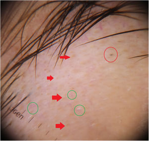Yellow dots (red arrow), empty follicular openings (gren circle), and black dot (red circle).