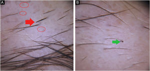 (A), Empty follicles (red circle), broken hair (red arrow). (B), Question mark hair (green arrow).
