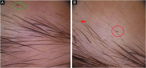 (A), Broken hair (red arrow), comma hair (red circle). (B), Tulip hair (green circle).