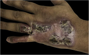 Erythematous and verrucous plaque, with nodules and crusts, located on the 4th and 5th fingers, in addition to the dorsal aspect of the left hand.