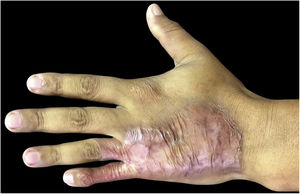 Clinical improvement after 4 months of treatment.
