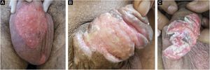 Chronic mucocutaneous herpes: clinical images of three male patients included in the study (A, Case 7; B, Case 6; C, Case 9).