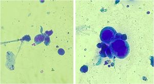 : Smear of lesions submitted to rapid panoptic staining, showing multinucleated epithelial cells, called Tzanck cells, suggesting viral inclusion by herpes virus (×400).