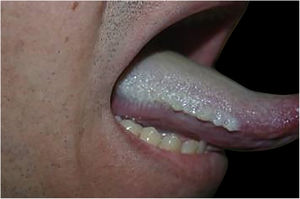 Whitish plaque with threadlike projections adhered to the right lateral border of the tongue.