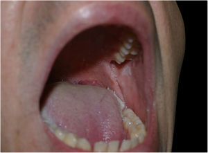 Whitish plaque on the left cheek mucosa.