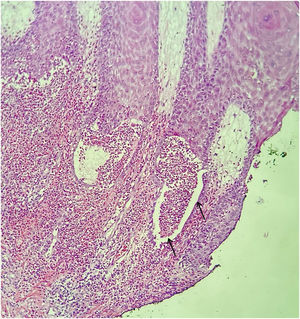 Light microscopy showing clefts and polymorphonuclear microabscess (Hematoxylin & eosin, ×150).