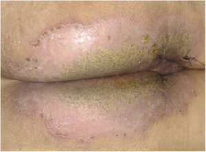 Clinical aspect with significant improvement after seven days of treatment, without the circinate pustular borders and mild verrucosity in the center.