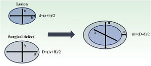 Estimation of final surgical margins based on lesion and defect measurements. Both lesions and defects were measured with length and width. They were averaged. Surgical margin (m) is then calculated as half of the difference between lesion and defect diameters (d, D). Adapted from: Schell AE et al.11 Suggested excisional margins for cutaneous malignant lesions based on Mohs micrographic surgery.