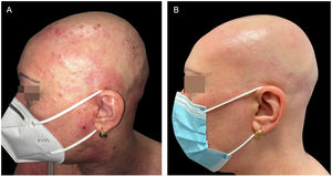 (A), The patient with severe AD, alopecia areata and molluscum contagiosum infection before treatment with dupilumab. Excoriation, eczematous lesions, and dome-shaped papules with central umbilication widespread all over the body but especially on her face and scalp. (B), Two months after starting treatment with dupilumab. Clinical remission of atopic dermatitis and resolution of molluscum contagiosum infection.