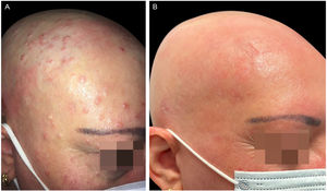 (A), The patient with severe AD, alopecia areata and molluscum contagiosum infection before treatment with dupilumab. Excoriation, eczematous lesions, and dome-shaped papules with central umbilication widespread all over the body but especially on her face and scalp. (B), Two months after starting treatment with dupilumab. Clinical remission of atopic dermatitis and resolution of molluscum contagiosum infection.
