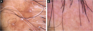 Trichoscopy with findings common to patients with LPP and FFA. (A), Peripilar desquamation and absence of follicular openings in a patient with LPP. (B), Mild peripilar desquamation and mild peripilar erythema in a patient with FFA.