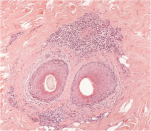 Histopathological: cross-sectionning (Hematoxylin & eosin, ×100). Presence of moderate perifollicular lymphocytic inflammatory infiltrates in the isthmus region.