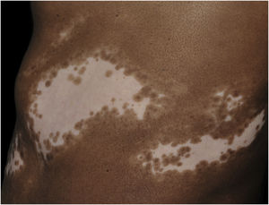 Segmental vitiligo on the flank of a dark-skinned patient. Achromic macula, with zosteriform distribution; the periphery of the lesion shows a leukomelanoderma band, with several follicular repigmentation points – Source: authors’ file.