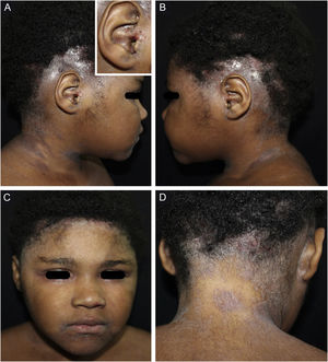 (A–D), Eczematous and exudative lesions on the scalp, with areas of alopecia, and excoriations in the external auditory canal. In A, a detail of the affected external auditory canal. C, infrapalpebral erythematoedematous areas and perilabial eczematous lesions. D, eczematous lesions in the cervical and retroauricular regions; occipital alopecia.