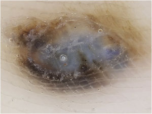 Dermoscopy showing a whitish-blue veil in the center and brownish pigment at the periphery, with a fibrillar pattern at one o