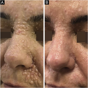 (A), On admission, multiple confluent, flesh-colored, infiltrated papules were detected on the nasal dorsum, bilateral alar grooves, and nasolabial regions. (B), At last control, the left nasolabial sulcus skin demonstrated a mild hypopigmentation. A prominent regression that was scored 80% by the patient was noted for the remaining parts receiving laser-assisted delivery of imiquimod.