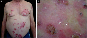 Patient numbered 2 in the Tables 1 and 2. (A), Crusted lesions above erythematous plaques in the anterior thorax and abdomen. (B), Milium lesions (white arrows) over cicatricial blistering lesions can be seen in a high magnification image.