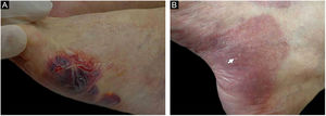 Patient numbered 4 in the Tables 1 and 2. (A), Hemorrhagic bullous and tense vesicle on erythematous plaques in the foot. (B), Milium lesions (white arrow) over cicatricial blistering lesions can be seen.