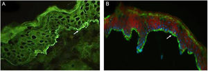 (A), Direct immunofluorescence of skin biopsy showing IgG linear fluorescence in the basement membrane zone (white arrow) (Patient 2) (immunofluorescence, 400×). (B), Indirect immunofluorescence using 1M-NaCl-Salt-split-skin shows IgG fluorescence on the cleavage epidermal side (Patient 5) (immunofluorescence, 400×).