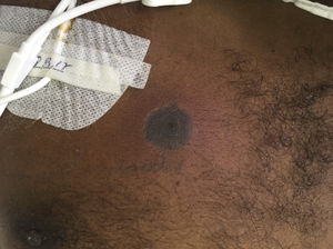 Single erythematous lesion with necrotic center in the anterior thoracic region, close to the Hickman catheter.