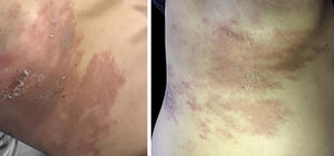 Brownish erythematous, desquamative plaque on the right hemithorax, with a diagnosis of metastatic breast carcinoma: topography of post-herpetic WIR.