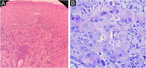 Histopathology of the right hemithorax plaque. A. Poorly differentiated carcinoma on the left, (Hematoxylin & eosin, ×100); B. on the right (Hematoxylin & eosin, ×400).