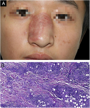 (A), Clinical image showing a red well-circumscribed plaque on his nasal dorsum with slightly raised border and a few scales on the surface. (B), The histopathology examination of the first biopsy shows cutaneous mixed inflammatory cells infiltration, including lymphocytes, histocytes, eosinophils and multinuclear giant cells, with numerous granulomas observed. (Hematoxylin & eosin, ×100).