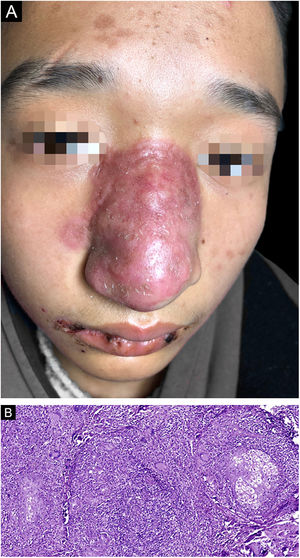 (A), The red plaques enlarged and involved almost the whole nasal dorsum when the patient visited again; (B), The histopathology of the second biopsy showed a similar histological profile as the first biopsy (Hematoxylin & eosin, ×200).