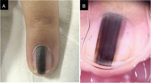 (A), Clinical aspect. (B), Dermoscopy: irregular color and thickness, loss of parallelism and blurred edges.