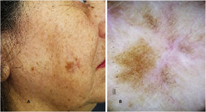 (A), Image of an asymmetric, brownish pigmented lesion on the face of a patient with sun photodamage. In the center of the lesion, a linear scar from a previous biopsy can be observed. (B), Dermoscopy of the lesion showing the presence of atypical pseudonetwork and areas of “peppering”.