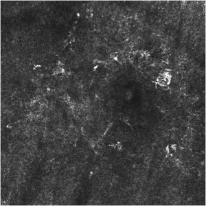 RCM image showing the presence of atypical pagetoid cells in the epidermis and atypical perifollicular dendritic cells, with loss of the epidermal structure.
