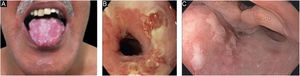 Mucosal involvement in epidermolysis bullosa acquisita. (A), Erosions on the dorsum of the tongue. (B), Bullae and erosions on the esophageal mucosa. (C), Erosions on the posterior wall of the hypopharynx.