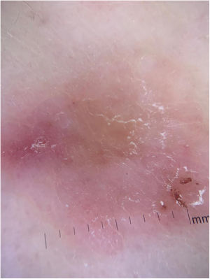 Dermoscopy showing the presence of white striae and microulcerations.