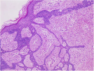 Long, thin, branched and anastomosed epithelial strands of basaloid cells originating from the epidermis embedded in a fibrous stroma. (Hematoxylin & eosin, ×100).