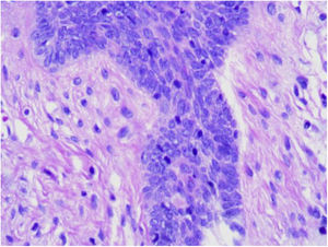 Epithelial cell clusters arranged in palisade can be seen along the epithelium, like “buds on a branch”. (Hematoxylin & eosin, ×400).