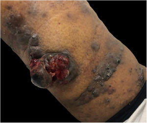 Significant increase in the number of satellite lesions and in the ulcerated area of the central tumor.