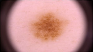 Brownish macula on dermoscopy showing a typical reticular pattern.