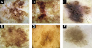 Dermoscopy. (A‒D), The four lesions of patient 1. (A), Right shoulder, lateral aspect. (B), Right shoulder, medial aspect. (C), Upper left scapular region. (D), Lower left scapular region. (E and F), The two lesions of patient 2. (E), Right forearm. (F), Left arm.