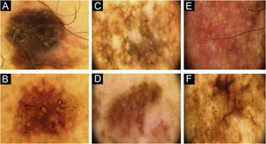 Dermoscopy. (A-B), The two lesions of patient 3. (A), Right arm. (B), Left zygomatic region. (C–D), The two lesions of patient 4. (C), Right scapular region. (D), Dorsum, left side. (E–F), The two lesions of patient 7. (E), Right arm. (F), Left trapezius.