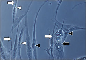 Fig. 1A magnification (×1000): senescent morphology of fibroblasts from skin with melasma, showing a higher proportion of juxtanuclear bodies (black arrow), frequent granular cytoplasmic structures (SA-β-gal+; white arrow), lipid droplets (white arrowhead), and segmented nucleoli (black arrowhead).