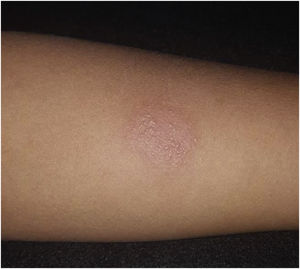 A strongly reactive 19mm PPD test.