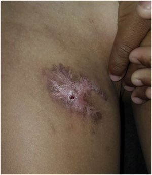 Evolution with significant lesion improvement, after a trial treatment for tuberculosis.