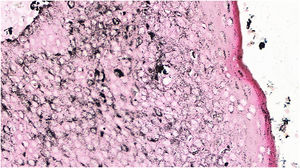 Pigmented eccrine poroma (Fontana-Masson, ×100). Diffuse intratumoral deposition of melanin granules, showing a greater intensity than that of the overlying epidermis.