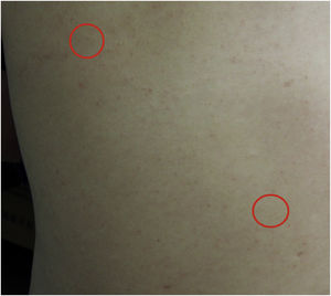 Clinical features at presentation. Two coin-sized subcutaneous nodules on the back (red circle), and the skin overlying the nodules was normal.