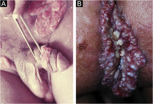 (A), Donovanosis: Vegetative ulcer with a bright red bottom (raised and/or everted edge). (B), Linear growth along, which may reach large dimensions, along the skinfolds. Clinical pictures belong to Prof. Sinésio Talhari private collection.